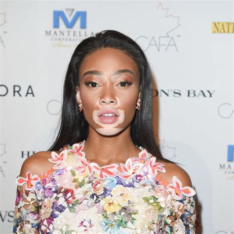 winnie harlow skin condition vitiligo